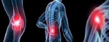 Нафталан лечение суставов