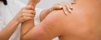 Лечение псориаза в Нафталане: Как добиться долгой ремиссии без гормонов (Цены 2026)